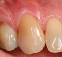  Scaling and root planing was performed to resolve the patient's infection and reduce gum pockets without surgery